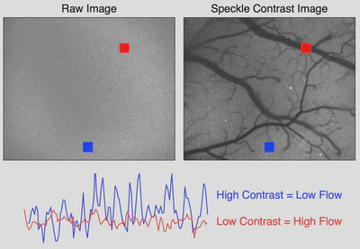 Objective speckle pattern (left) and resulting laser speckle contrast image (right). The region with higher flow (red) has lower contrast than the region with low flow (blue).