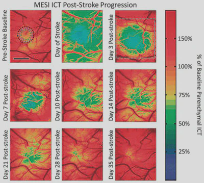 **Chronic imaging of perfusion after ischemic stroke:** MESI used to track cerebral perfusion following an induced photothrombotic stroke. Green denotes areas with moderate flow deficit, while blue denotes areas with severe flow deficit ([Schrandt, 2015](/publication/schrandt-2015/)).