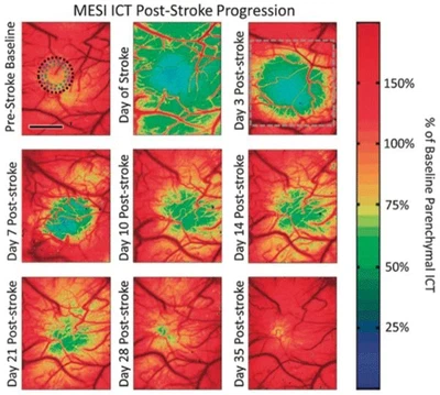 **Chronic imaging of perfusion after ischemic stroke:** MESI used to track cerebral perfusion following an induced photothrombotic stroke. Green denotes areas with moderate flow deficit, while blue denotes areas with severe flow deficit ([Schrandt, 2015](/publication/schrandt-2015/)).